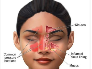 SINUS SURGERY COST IN INDIA